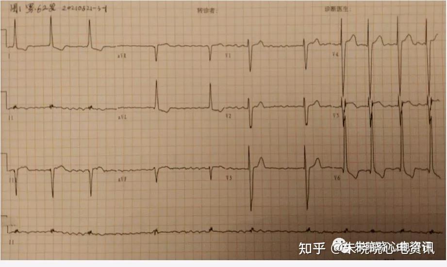 阵发性室上性心动过速的治疗方法与注意事项