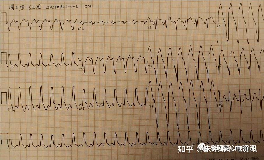 阵发性室上性心动过速的治疗_阵发性室性心动过_阵发性房性心动