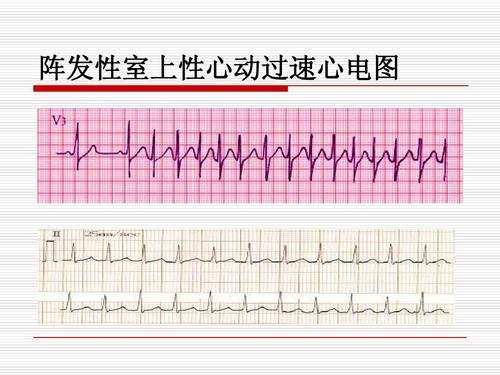 阵发性室上性心动过速治疗_阵发性房性心动_阵发性房动心动过速