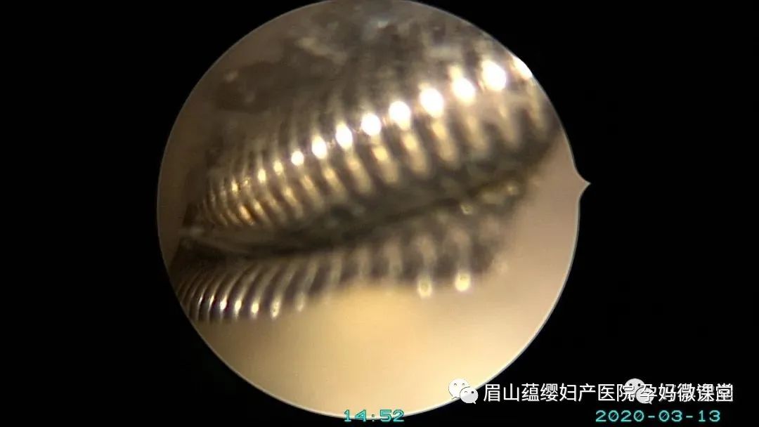 宫型环是最难取的环吗-宫型环取环难如减肥？姐妹们直呼比酷刑还痛苦
