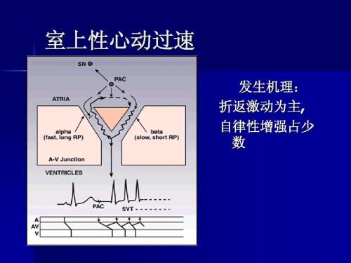 心室阵发性心动过速_阵发性室性心动过_阵发室上性心动过速