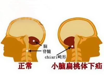 小脑梗最佳恢复方法_小脑共济性失调怎么治疗_小脑