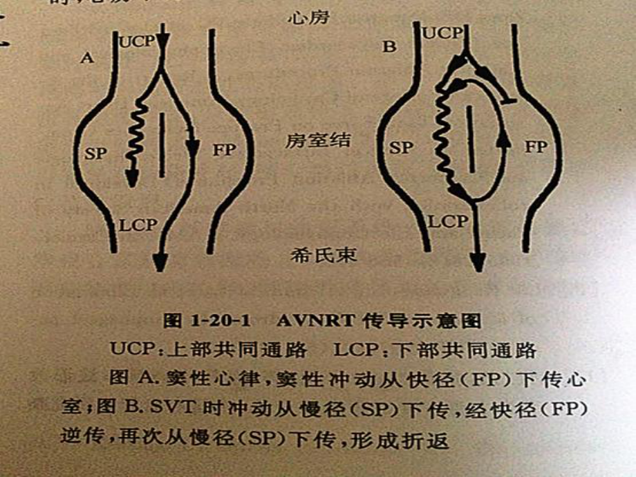 阵发性室上性心动过扑_心室扑动室性心动过速_阵发心房扑动